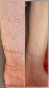 Avant après réparation d'une cicatrice blanche par dermopigmentation