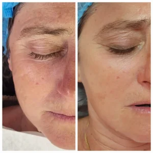 Atténuation des rides profondes & ridules SkinRepairs5