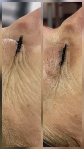 Atténuation des rides profondes & ridules SkinRepairs6