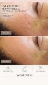 camouflage des cicatrices-Skinrepairs